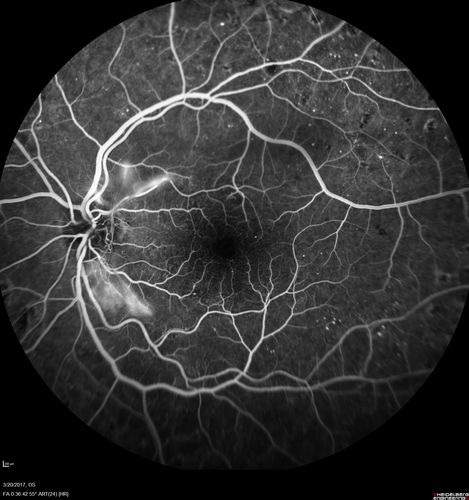 Proliferative Diabetic Retinopathy - NVD regressed with PRP laser
76 year old diabetic man - Presented one year ago with NVD in the left eye.  This regressed with laser but then a year later worsened.  Additional PRP was done and the NVD regressed again.
