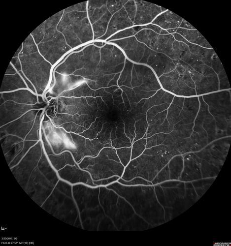 Proliferative Diabetic Retinopathy - NVD regressed with PRP laser
76 year old diabetic man - Presented one year ago with NVD in the left eye.  This regressed with laser but then a year later worsened.  Additional PRP was done and the NVD regressed again.
