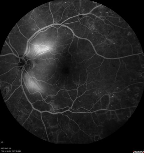 Proliferative Diabetic Retinopathy - NVD regressed with PRP laser
76 year old diabetic man - Presented one year ago with NVD in the left eye.  This regressed with laser but then a year later worsened.  Additional PRP was done and the NVD regressed again.
