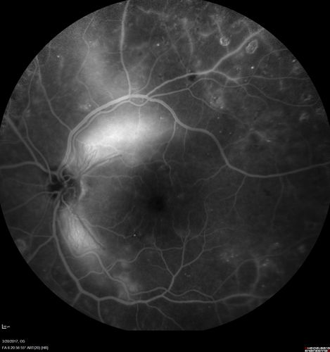 Proliferative Diabetic Retinopathy - NVD regressed with PRP laser
76 year old diabetic man - Presented one year ago with NVD in the left eye.  This regressed with laser but then a year later worsened.  Additional PRP was done and the NVD regressed again.
