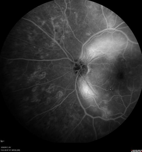 Proliferative Diabetic Retinopathy - NVD regressed with PRP laser
76 year old diabetic man - Presented one year ago with NVD in the left eye.  This regressed with laser but then a year later worsened.  Additional PRP was done and the NVD regressed again.
