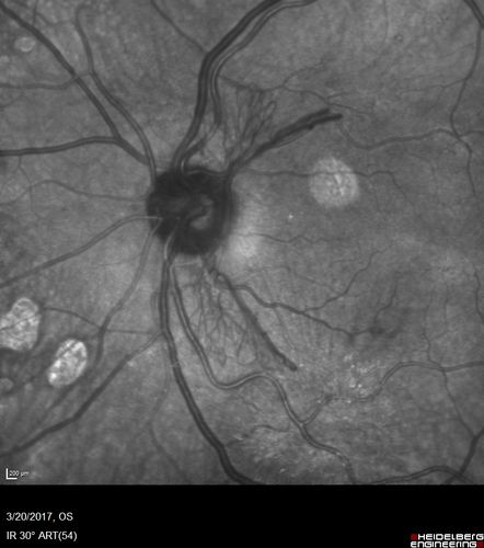 Proliferative Diabetic Retinopathy - NVD regressed with PRP laser - Recurrence one year after initial laser
76 year old diabetic man - Presented one year ago with NVD in the left eye.  This regressed with laser but then a year later worsened.  Additional PRP was done and the NVD regressed again.
