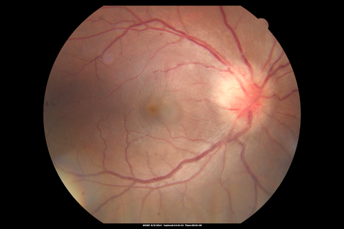 Neuroretinitis - Cat Scratch - Bartonella - Sudden Vision Loss Right Eye - 29 Year Old Female
