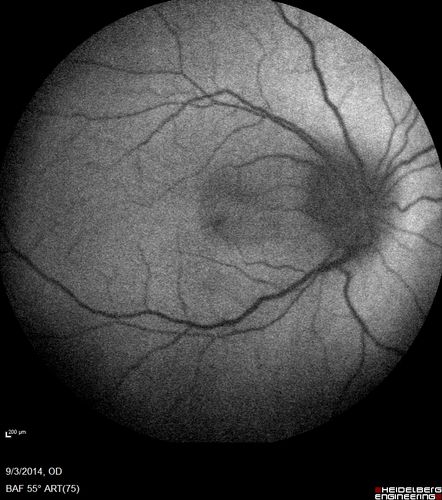Neuroretinitis - Cat Scratch - Bartonella - Sudden Vision Loss Right Eye - 29 Year Old Female
