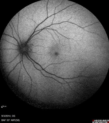 Neuroretinitis Positive IgM Bartonella henselae
33 year old with vision loss.  Her vision improved and she was treated with ciprofloxacen
