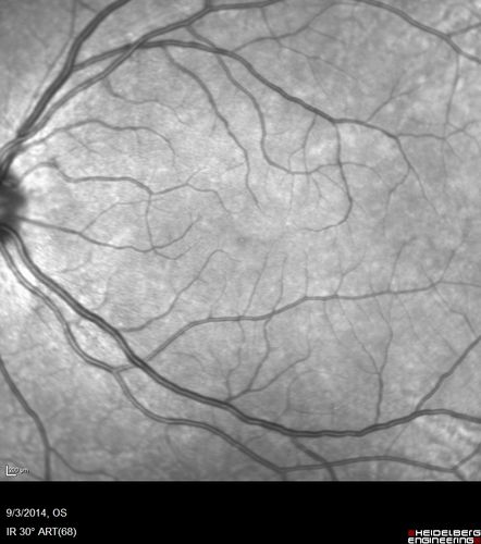 Neuroretinitis Positive IgM Bartonella henselae
33 year old with vision loss.  Her vision improved and she was treated with ciprofloxacen
