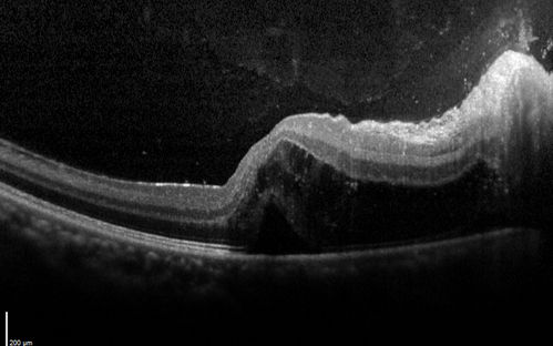 Neuroretinitis Positive IgM Bartonella henselae
33 year old with vision loss.  Her vision improved and she was treated with ciprofloxacen
