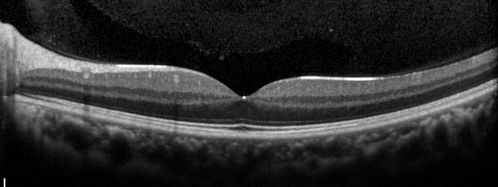 Neuroretinitis - Cat Scratch - Bartonella - Sudden Vision Loss Right Eye - 29 Year Old Female
