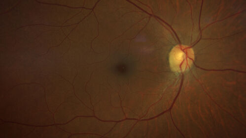 Neuroretinitis left eye - recovered with no therapy - possible B pertussis
57 year old female The patient has had blurred vision in the left eye and there is a haze across the top of the vision.Â  This started about 2 weeks ago.Â  The right eye is OK.Â  She has sleep apnea and uses the machine.Â  The left eye is becoming more and more painful for the last two weeks.Â  The pain is like a stabbing in the eye that comes and goes.Â  She also has some pain on eye movement.Â  The patient has been going to Moffit for possible reconstructive surgery for the lymphedema.
PMHx â€“ Sleep apnea, Breast Cancer, Adult lymphedema, 
Meds: GabapentinÂ 
VA OD: Dcc20/25-1
VA OS: Dcc20/100-2
AC quiet OU.  1 + NS cataract OU
IOP: TP: OD:15 OS:17

