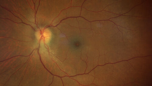 Neuroretinitis left eye - recovered with no therapy - possible B pertussis
57 year old female The patient has had blurred vision in the left eye and there is a haze across the top of the vision.Â  This started about 2 weeks ago.Â  The right eye is OK.Â  She has sleep apnea and uses the machine.Â  The left eye is becoming more and more painful for the last two weeks.Â  The pain is like a stabbing in the eye that comes and goes.Â  She also has some pain on eye movement.Â  The patient has been going to Moffit for possible reconstructive surgery for the lymphedema.
PMHx â€“ Sleep apnea, Breast Cancer, Adult lymphedema, 
Meds: GabapentinÂ 
VA OD: Dcc20/25-1
VA OS: Dcc20/100-2
AC quiet OU.  1 + NS cataract OU
IOP: TP: OD:15 OS:17
