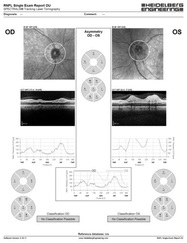 Neuroretinitis left eye - recovered with no therapy - possible B pertussis
57 year old female The patient has had blurred vision in the left eye and there is a haze across the top of the vision.Â  This started about 2 weeks ago.Â  The right eye is OK.Â  She has sleep apnea and uses the machine.Â  The left eye is becoming more and more painful for the last two weeks.Â  The pain is like a stabbing in the eye that comes and goes.Â  She also has some pain on eye movement.Â  The patient has been going to Moffit for possible reconstructive surgery for the lymphedema.
PMHx â€“ Sleep apnea, Breast Cancer, Adult lymphedema, 
Meds: GabapentinÂ 
VA OD: Dcc20/25-1
VA OS: Dcc20/100-2
AC quiet OU.  1 + NS cataract OU
IOP: TP: OD:15 OS:17
