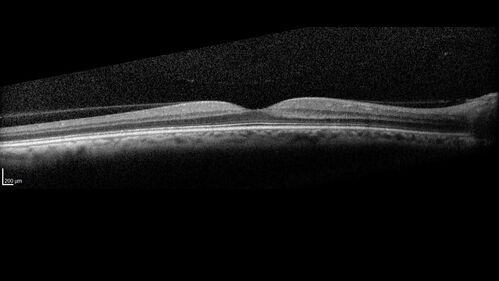 Neuroretinitis left eye - recovered with no therapy - possible B pertussis
57 year old female The patient has had blurred vision in the left eye and there is a haze across the top of the vision.Â  This started about 2 weeks ago.Â  The right eye is OK.Â  She has sleep apnea and uses the machine.Â  The left eye is becoming more and more painful for the last two weeks.Â  The pain is like a stabbing in the eye that comes and goes.Â  She also has some pain on eye movement.Â  The patient has been going to Moffit for possible reconstructive surgery for the lymphedema.
PMHx â€“ Sleep apnea, Breast Cancer, Adult lymphedema, 
Meds: GabapentinÂ 
VA OD: Dcc20/25-1
VA OS: Dcc20/100-2
AC quiet OU.  1 + NS cataract OU
IOP: TP: OD:15 OS:17
