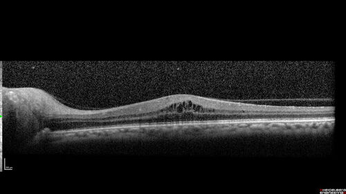 Neuroretinitis left eye - recovered with no therapy - possible B pertussis
57 year old female The patient has had blurred vision in the left eye and there is a haze across the top of the vision.Â  This started about 2 weeks ago.Â  The right eye is OK.Â  She has sleep apnea and uses the machine.Â  The left eye is becoming more and more painful for the last two weeks.Â  The pain is like a stabbing in the eye that comes and goes.Â  She also has some pain on eye movement.Â  The patient has been going to Moffit for possible reconstructive surgery for the lymphedema.
PMHx â€“ Sleep apnea, Breast Cancer, Adult lymphedema, 
Meds: GabapentinÂ 
VA OD: Dcc20/25-1
VA OS: Dcc20/100-2
AC quiet OU.  1 + NS cataract OU
IOP: TP: OD:15 OS:17
