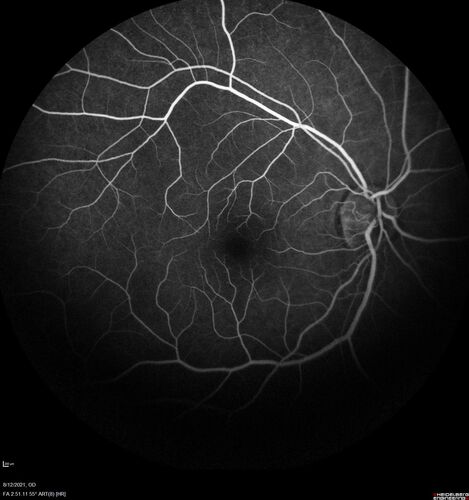 Neuroretinitis left eye - recovered with no therapy - possible B pertussis
57 year old female The patient has had blurred vision in the left eye and there is a haze across the top of the vision.Â  This started about 2 weeks ago.Â  The right eye is OK.Â  She has sleep apnea and uses the machine.Â  The left eye is becoming more and more painful for the last two weeks.Â  The pain is like a stabbing in the eye that comes and goes.Â  She also has some pain on eye movement.Â  The patient has been going to Moffit for possible reconstructive surgery for the lymphedema.
PMHx â€“ Sleep apnea, Breast Cancer, Adult lymphedema, 
Meds: GabapentinÂ 
VA OD: Dcc20/25-1
VA OS: Dcc20/100-2
AC quiet OU.  1 + NS cataract OU
IOP: TP: OD:15 OS:17
