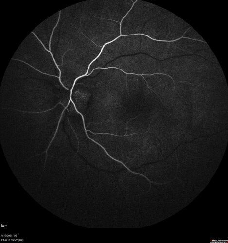 Neuroretinitis left eye - recovered with no therapy - possible B pertussis
57 year old female The patient has had blurred vision in the left eye and there is a haze across the top of the vision.Â  This started about 2 weeks ago.Â  The right eye is OK.Â  She has sleep apnea and uses the machine.Â  The left eye is becoming more and more painful for the last two weeks.Â  The pain is like a stabbing in the eye that comes and goes.Â  She also has some pain on eye movement.Â  The patient has been going to Moffit for possible reconstructive surgery for the lymphedema.
PMHx â€“ Sleep apnea, Breast Cancer, Adult lymphedema, 
Meds: GabapentinÂ 
VA OD: Dcc20/25-1
VA OS: Dcc20/100-2
AC quiet OU.  1 + NS cataract OU
IOP: TP: OD:15 OS:17
