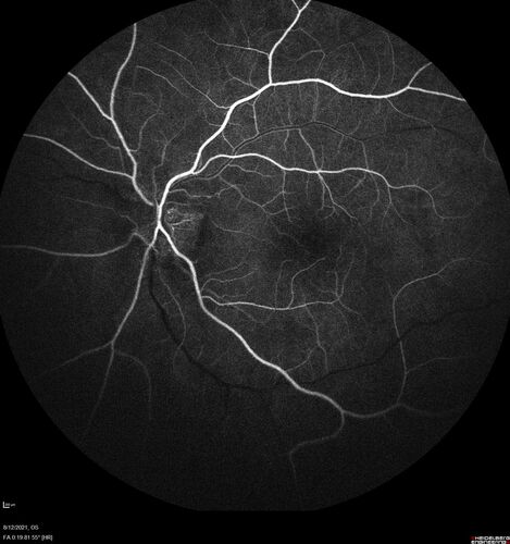Neuroretinitis left eye - recovered with no therapy - possible B pertussis
57 year old female The patient has had blurred vision in the left eye and there is a haze across the top of the vision.Â  This started about 2 weeks ago.Â  The right eye is OK.Â  She has sleep apnea and uses the machine.Â  The left eye is becoming more and more painful for the last two weeks.Â  The pain is like a stabbing in the eye that comes and goes.Â  She also has some pain on eye movement.Â  The patient has been going to Moffit for possible reconstructive surgery for the lymphedema.
PMHx â€“ Sleep apnea, Breast Cancer, Adult lymphedema, 
Meds: GabapentinÂ 
VA OD: Dcc20/25-1
VA OS: Dcc20/100-2
AC quiet OU.  1 + NS cataract OU
IOP: TP: OD:15 OS:17

