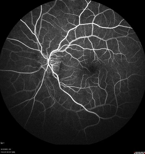 Neuroretinitis left eye - recovered with no therapy - possible B pertussis
57 year old female The patient has had blurred vision in the left eye and there is a haze across the top of the vision.Â  This started about 2 weeks ago.Â  The right eye is OK.Â  She has sleep apnea and uses the machine.Â  The left eye is becoming more and more painful for the last two weeks.Â  The pain is like a stabbing in the eye that comes and goes.Â  She also has some pain on eye movement.Â  The patient has been going to Moffit for possible reconstructive surgery for the lymphedema.
PMHx â€“ Sleep apnea, Breast Cancer, Adult lymphedema, 
Meds: GabapentinÂ 
VA OD: Dcc20/25-1
VA OS: Dcc20/100-2
AC quiet OU.  1 + NS cataract OU
IOP: TP: OD:15 OS:17
