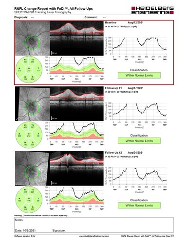 Neuroretinitis left eye - recovered with no therapy - possible B pertussis
57 year old female The patient has had blurred vision in the left eye and there is a haze across the top of the vision.Â  This started about 2 weeks ago.Â  The right eye is OK.Â  She has sleep apnea and uses the machine.Â  The left eye is becoming more and more painful for the last two weeks.Â  The pain is like a stabbing in the eye that comes and goes.Â  She also has some pain on eye movement.Â  The patient has been going to Moffit for possible reconstructive surgery for the lymphedema.
PMHx â€“ Sleep apnea, Breast Cancer, Adult lymphedema, 
Meds: GabapentinÂ 
VA OD: Dcc20/25-1
VA OS: Dcc20/100-2
AC quiet OU.  1 + NS cataract OU
IOP: TP: OD:15 OS:17
