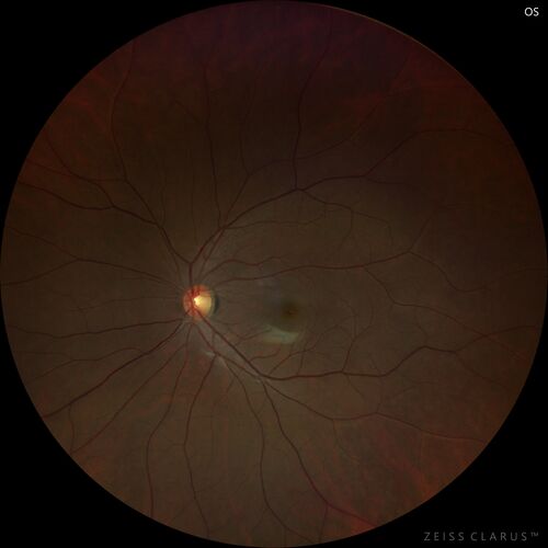 Normal Clarus Image
