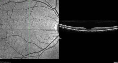 Normal OCT line scan
