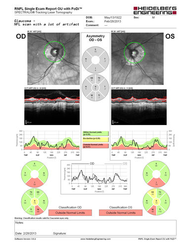 Normal Tension Glaucoma - Nerve Fiber Layer Scan is difficult to read because of artifact from peripapillary atrophy
90 Year old man: IOP 9 OD, 11 OS
