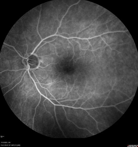Normal Fluorescein Angiogram  02
