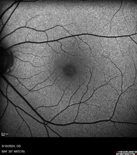 Normal Autofluorescence
