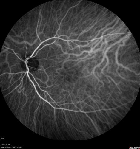 Normal Indocyanine Green Angiogram  02
