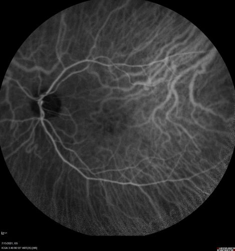 Normal Indocyanine Green Angiogram  03
