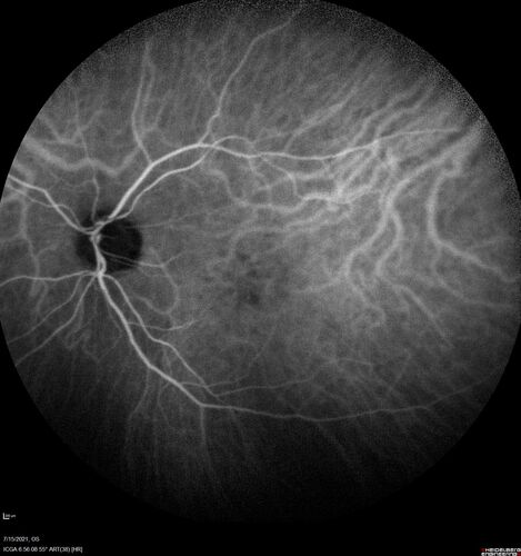 Normal Indocyanine Green Angiogram  04
