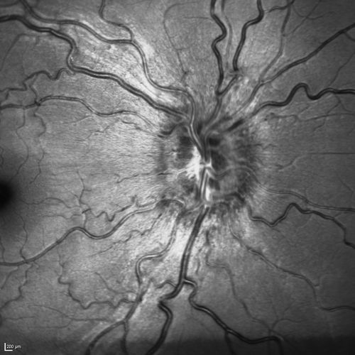 Optic Nerve (Disc) Drusen - Infrared Reflectance
34 Year Old woman no headaches normal vision
