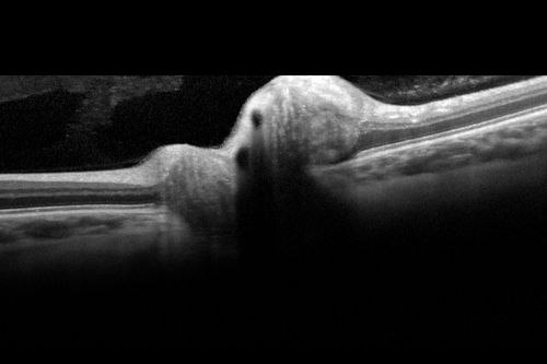 Optic Nerve (Disc) Drusen - Spectral Domain Optical Coherence Tomography Line Scan
34 Year Old woman no headaches normal vision
