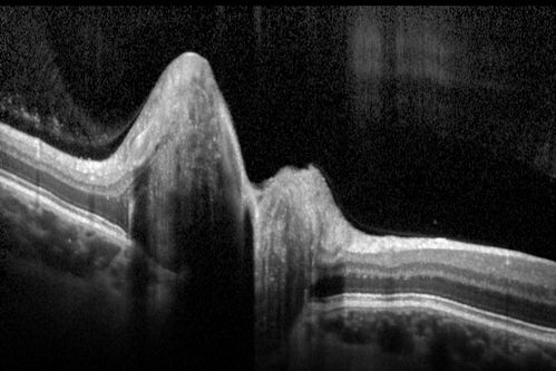 Optic Nerve (Disc) Drusen - Spectral Domain Optical Coherence Tomography Line Scan
34 Year Old woman no headaches normal vision
