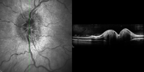 Optic Nerve (Disc) Drusen - Spectral Domain Optical Coherence Tomography Line Scan
34 Year Old woman no headaches normal vision
