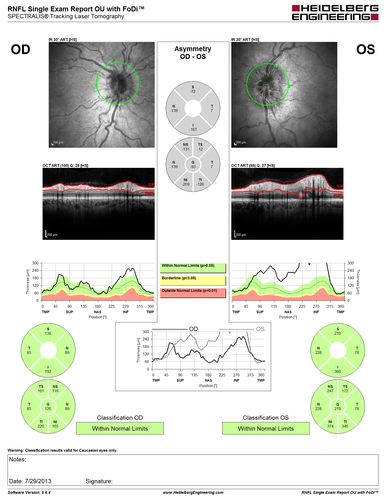 Optic Nerve (Disc) Drusen - RNFL Scan
34 Year Old woman no headaches normal vision

