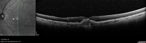 Conversion to Wet AMD after Izervay
83 year  old  man whose  left eye had minimal GA and converted from dry to wet AMD after a single Izervay treatment
