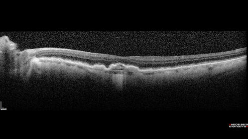 Conversion to Wet AMD after Izervay
83 year  old  man whose  left eye had minimal GA and converted from dry to wet AMD after a single Izervay treatment

