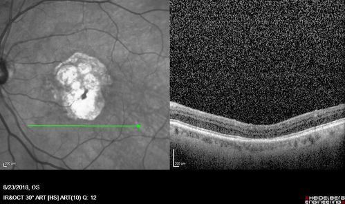 Outer Retinal Tubulation
78 year old man chronic wet AMD - 20/200
