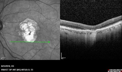 Outer Retinal Tubulation
78 year old man chronic wet AMD - 20/200
