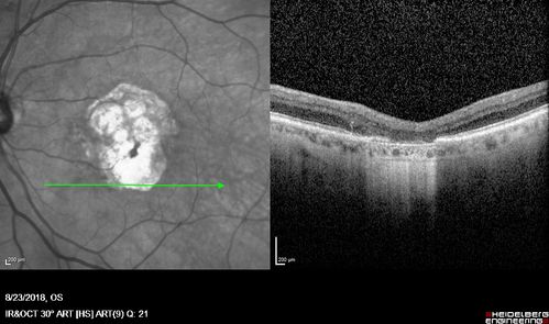 Outer Retinal Tubulation
78 year old man chronic wet AMD - 20/200
