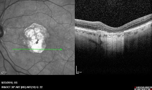 Outer Retinal Tubulation
78 year old man chronic wet AMD - 20/200
