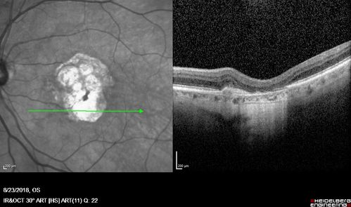 Outer Retinal Tubulation
78 year old man chronic wet AMD - 20/200

