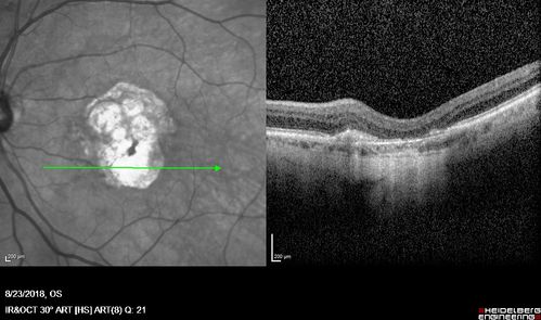 Outer Retinal Tubulation
78 year old man chronic wet AMD - 20/200
