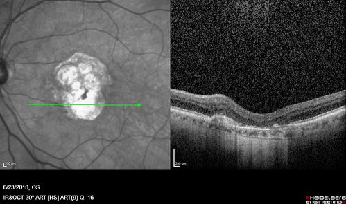 Outer Retinal Tubulation
78 year old man chronic wet AMD - 20/200
