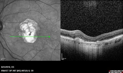Outer Retinal Tubulation
78 year old man chronic wet AMD - 20/200
