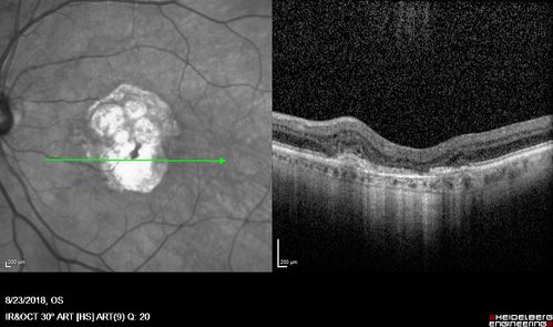 Outer Retinal Tubulation
78 year old man chronic wet AMD - 20/200
