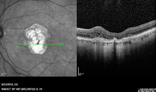 Outer Retinal Tubulation
78 year old man chronic wet AMD - 20/200

