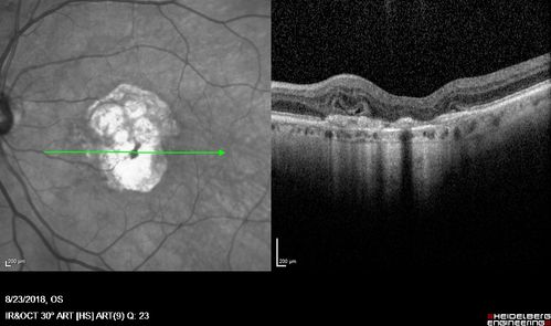 Outer Retinal Tubulation
78 year old man chronic wet AMD - 20/200

