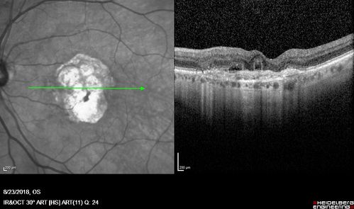 Outer Retinal Tubulation
78 year old man chronic wet AMD - 20/200
