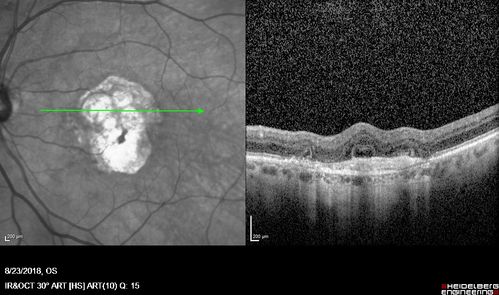 Outer Retinal Tubulation
78 year old man chronic wet AMD - 20/200
